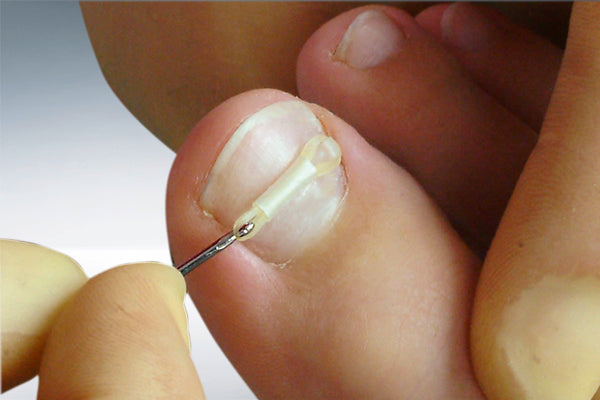 ERKI Nagelkorrektur-Set – Spangen-System zur Nagelkorrektur