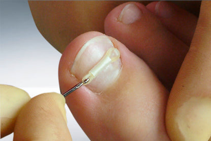 ERKI Nagelkorrektur-Set – Spangen-System zur Nagelkorrektur